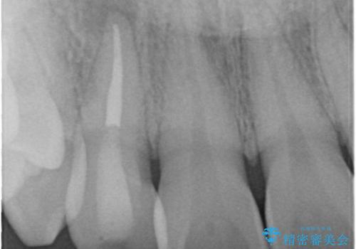 前歯の根管治療の症例 治療後