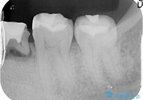 乳歯の晩期残存　永久歯がない　矯正とインプラントによる治療の治療前