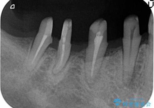 歯を残す歯周病再生治療 ② (歯根分割・歯周補綴)の治療中
