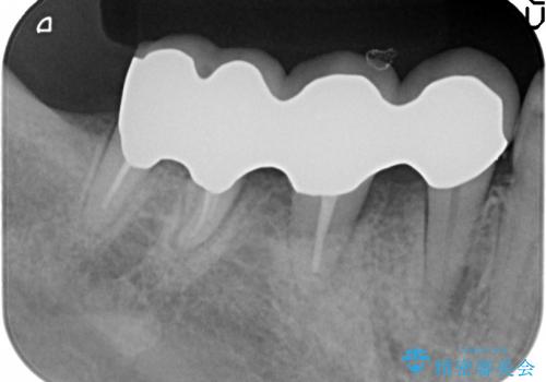歯を残す歯周病再生治療 ② (歯根分割・歯周補綴)の治療後
