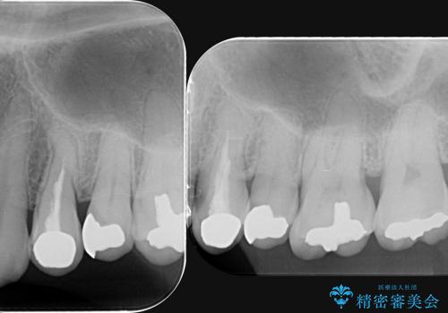 [メタルフリー治療]  銀歯を白く emaxを用いた審美修復・補綴の治療前