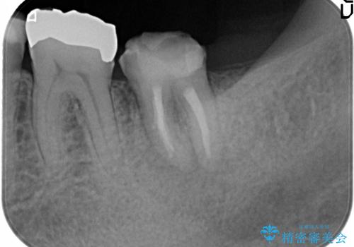 40代男性　痛む奥歯の原因療法　の治療中