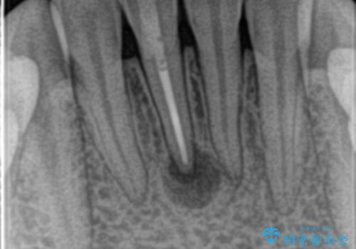 下の前歯　精密根管治療の症例 治療後