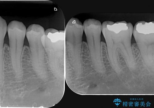 [メタルフリー治療]  銀歯を白く emaxを用いた審美修復・補綴の治療前
