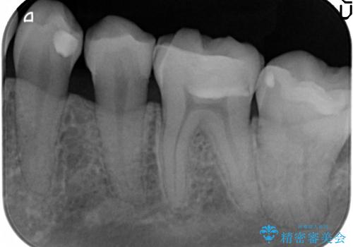 セラミックインレーによる虫歯治療の治療後