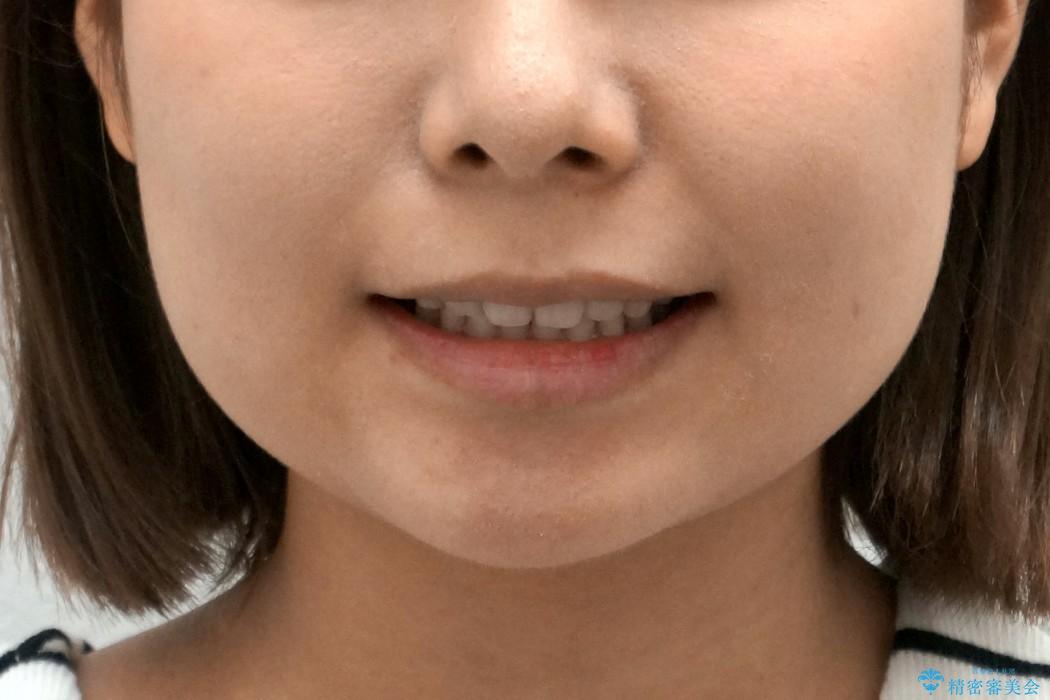インビザライン　過蓋咬合の治療　ワイヤーでは難しい症例　歯を抜かない治療の治療後（顔貌）