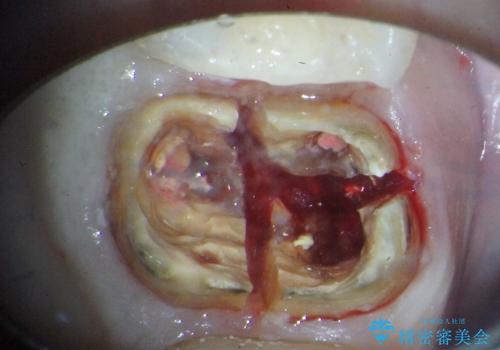 歯の違和感を顕微鏡を用いて精査　オールセラミックジルコニアブリッジによる治療の治療前