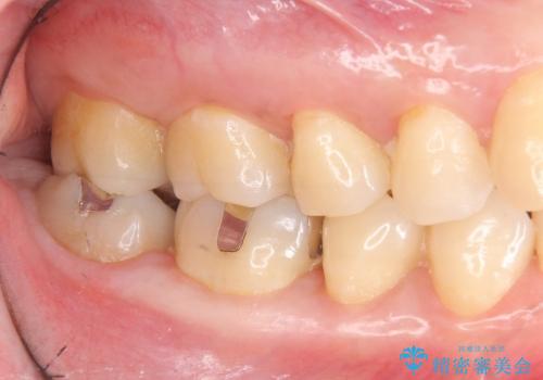 大きな銀歯を白くの治療前
