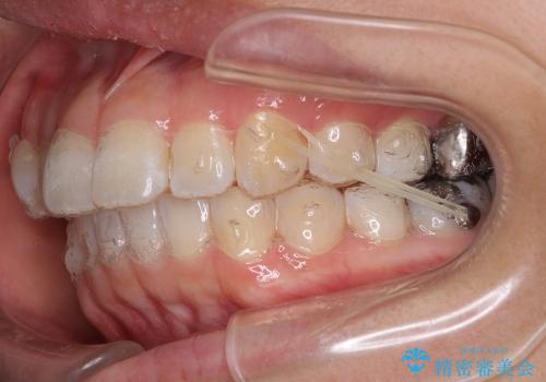 インビザラインで歯を抜かずに八重歯の治療の治療中