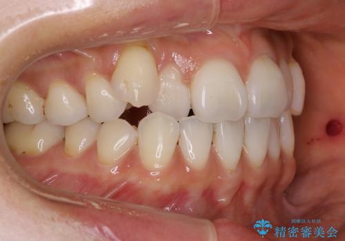 30代女性　インビザラインを用いた八重歯の矯正治療の治療前