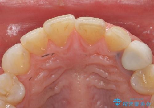 オールセラミッククラウンによる前歯の審美的補綴の治療前