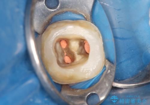 40代男性　痛む奥歯の原因療法　の治療中