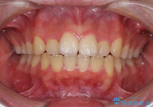 インビザラインによる前歯のでこぼこの改善の症例 治療前