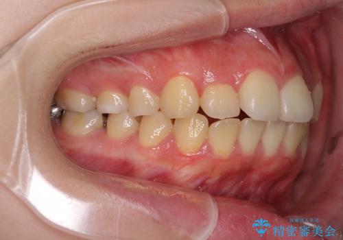 インビザラインによる前歯のでこぼこの改善の治療前