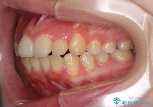 インビザラインによる前歯のでこぼこの改善の治療前