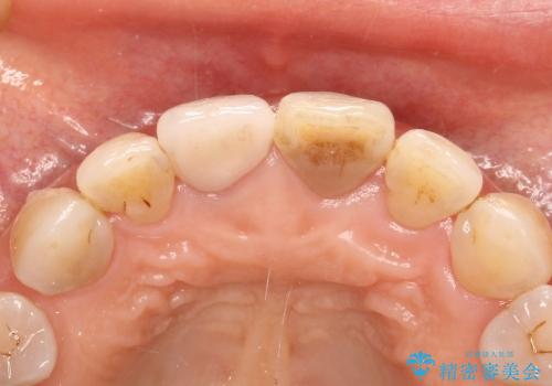 前歯の被せものの治療後