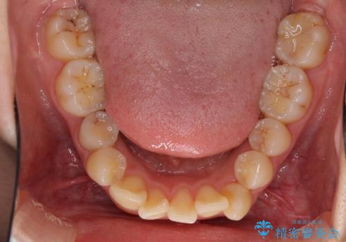 矯正による八重歯の審美治療の治療中