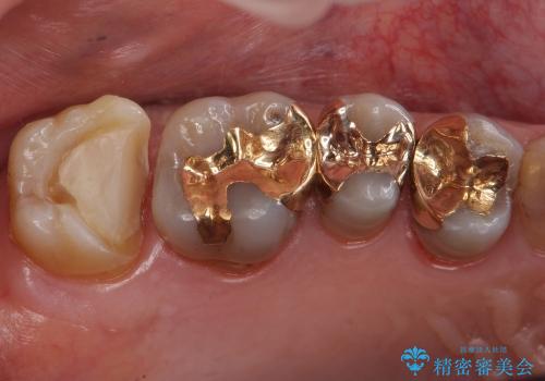 歯が欠けて大きな穴に　セラミックインレー修復の治療中