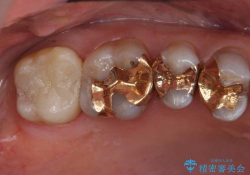 歯が欠けて大きな穴に　セラミックインレー修復の治療後