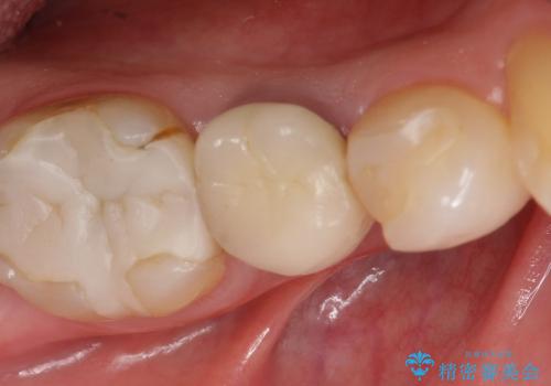 セラミックによる虫歯治療の治療前