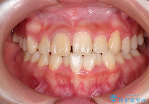 矯正治療に伴う犬歯埋伏抜歯の治療前