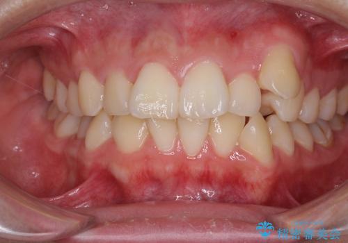 矯正による八重歯の審美治療の症例 治療前