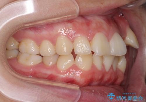 矯正による八重歯の審美治療の治療前