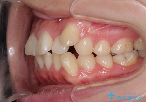 矯正による八重歯の審美治療の治療前