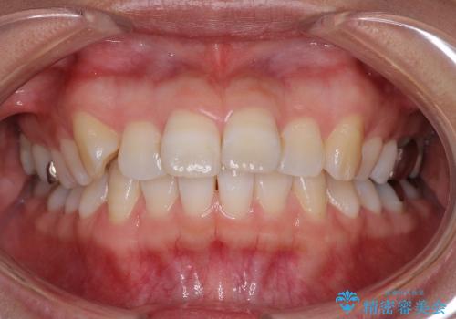 インビザラインで歯を抜かずに八重歯の治療の治療前