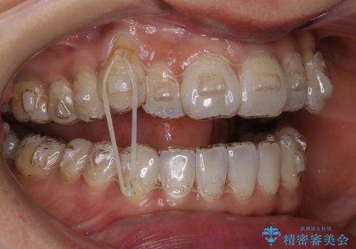 30代女性　インビザラインを用いた八重歯の矯正治療