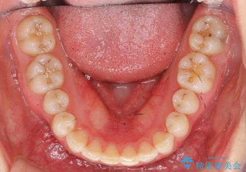 インビザライン　過蓋咬合の治療　ワイヤーでは難しい症例　歯を抜かない治療の治療後