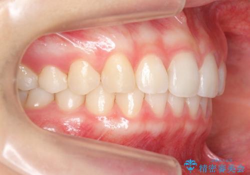 インビザライン　過蓋咬合の治療　ワイヤーでは難しい症例　歯を抜かない治療の治療後