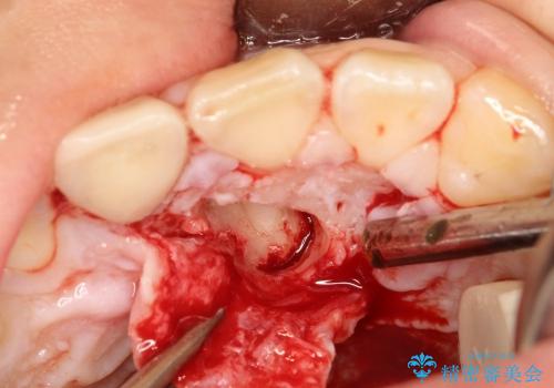 20代男性　過剰埋伏歯の抜歯の治療中
