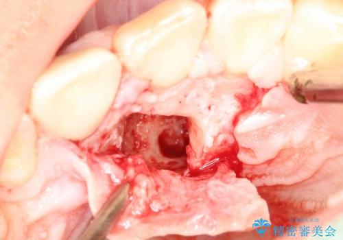 20代男性　過剰埋伏歯の抜歯の治療中