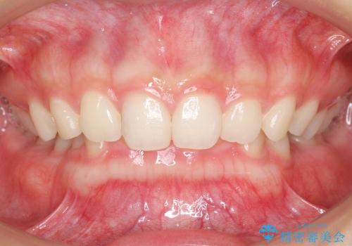 インビザライン　過蓋咬合の治療　ワイヤーでは難しい症例　歯を抜かない治療の治療前