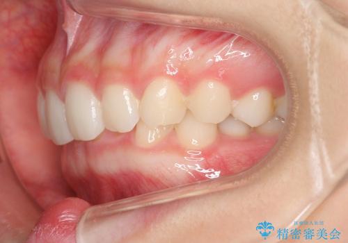 インビザライン　過蓋咬合の治療　ワイヤーでは難しい症例　歯を抜かない治療の治療前