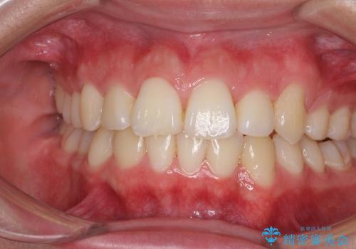 矯正による八重歯の審美治療の症例 治療後