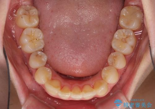 矯正による八重歯の審美治療の治療後
