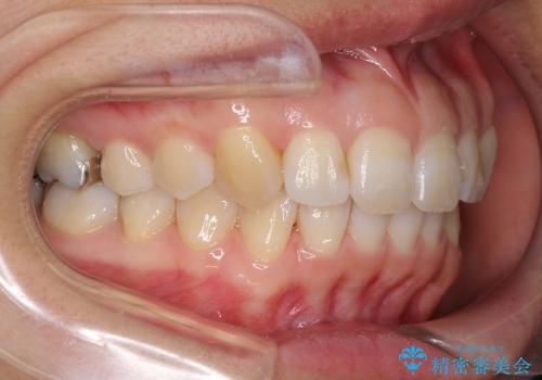 インビザラインで歯を抜かずに八重歯の治療の治療後