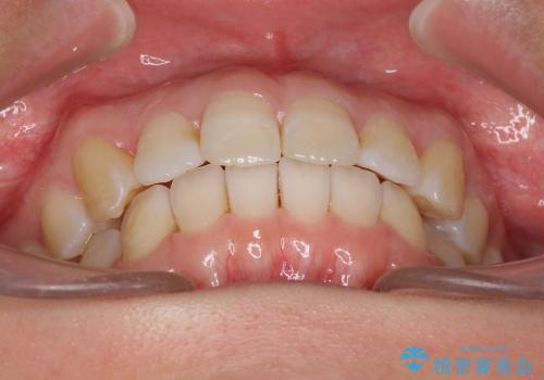 インビザラインで歯を抜かずに八重歯の治療の治療後