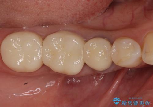 念願のメタルフリー　奥歯の目立つ銀歯を全てセラミックにの治療後