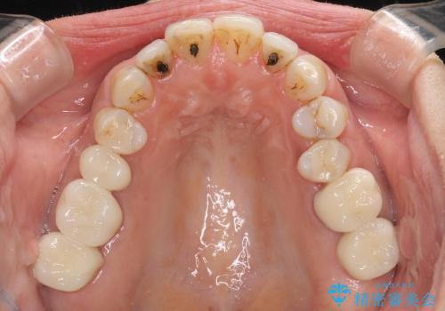 念願のメタルフリー　奥歯の目立つ銀歯を全てセラミックにの治療後