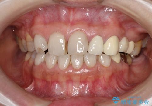 歯の悩みを一気に解決　総合歯科診療の症例 治療前