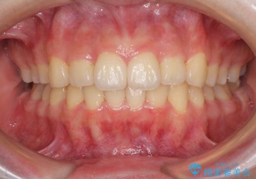 インビザラインによる前歯のでこぼこの改善の症例 治療後