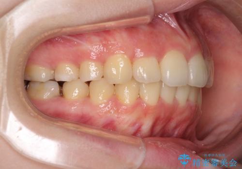 インビザラインによる前歯のでこぼこの改善の治療後