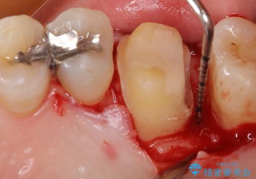 20代女性　深すぎる虫歯に対する歯周外科と被せもの治療の治療中