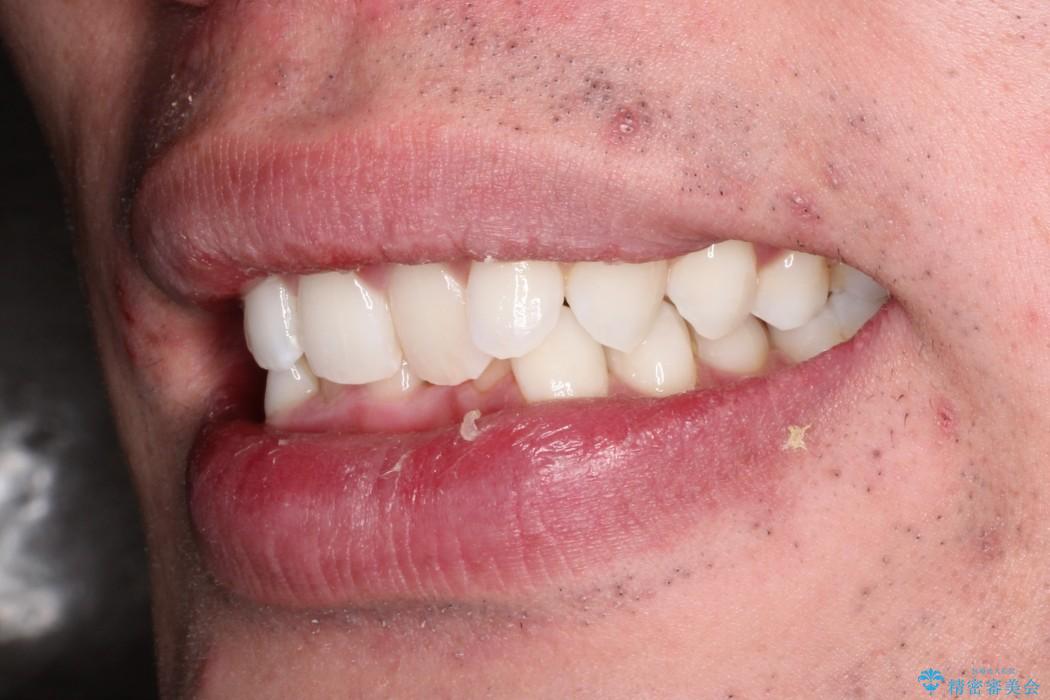 30代男性　インビザラインによる過蓋咬合の改善の治療前（顔貌）