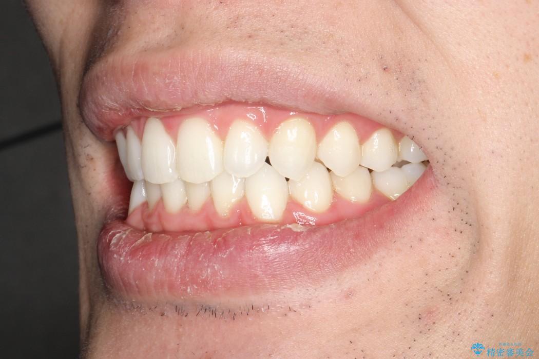 30代男性　インビザラインによる過蓋咬合の改善の治療後（顔貌）