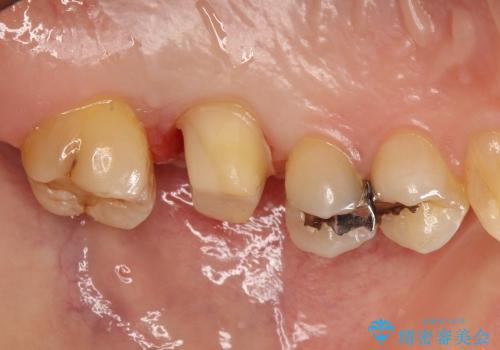 20代女性　深すぎる虫歯に対する歯周外科と被せもの治療の治療中