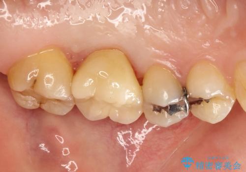 20代女性　深すぎる虫歯に対する歯周外科と被せもの治療の治療後
